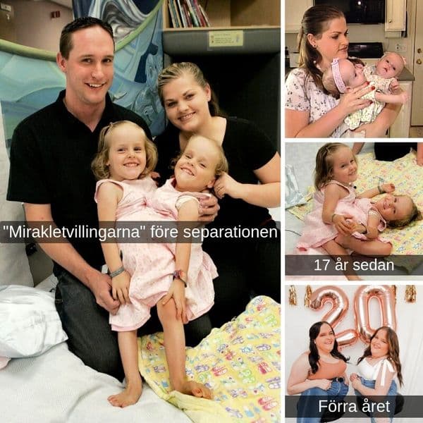 Var har hänt med dessa tidigare sammanfogade tvillingar nu❓