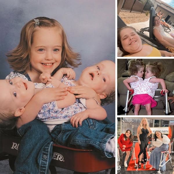 Эти бывшие сросшиеся близнецы уже выросли, вот они какие теперь