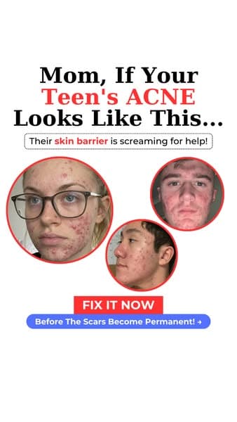 10 Seconds/Day To Clear Skin