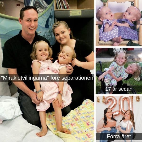 Var har hänt med dessa tidigare sammanfogade tvillingar nu❓