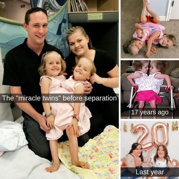 Where Are These Formerly Conjoined Twins Now❓
