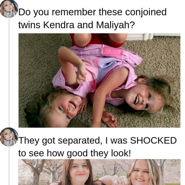 These Formerly Conjoined Twins Are All Grown Up, This Is Them Now